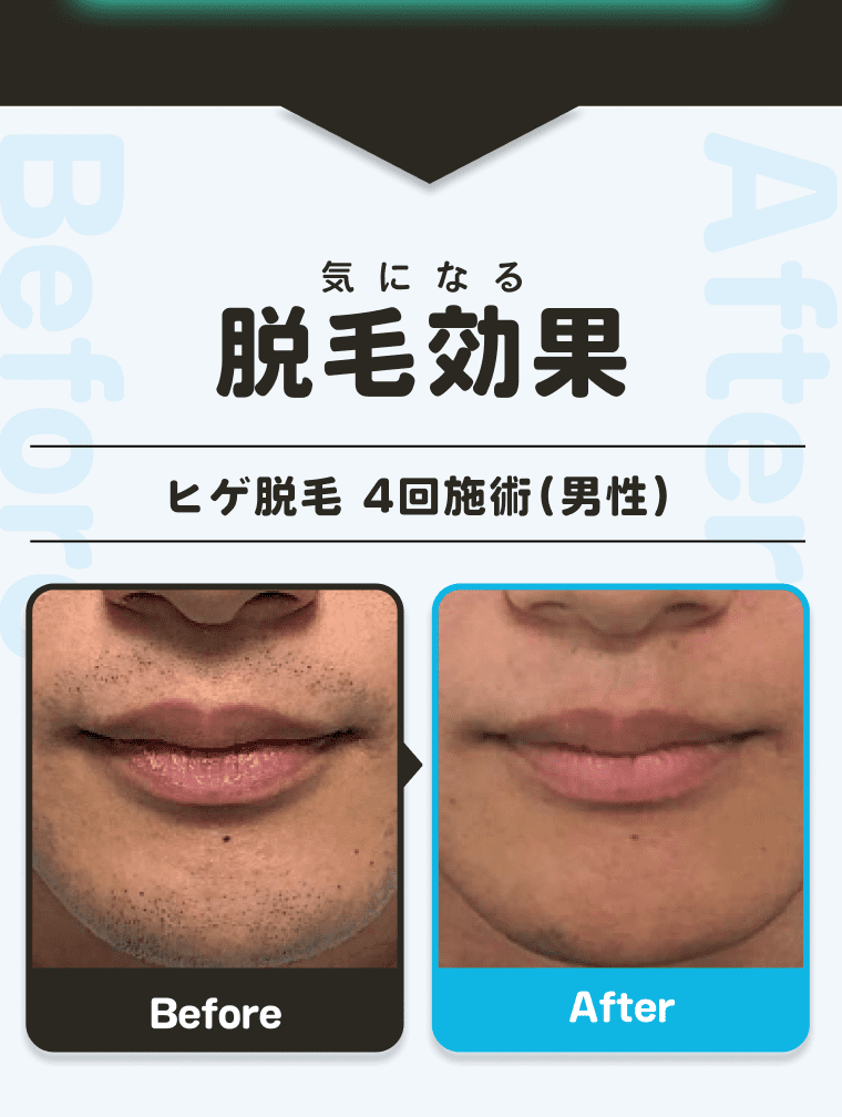 脱毛