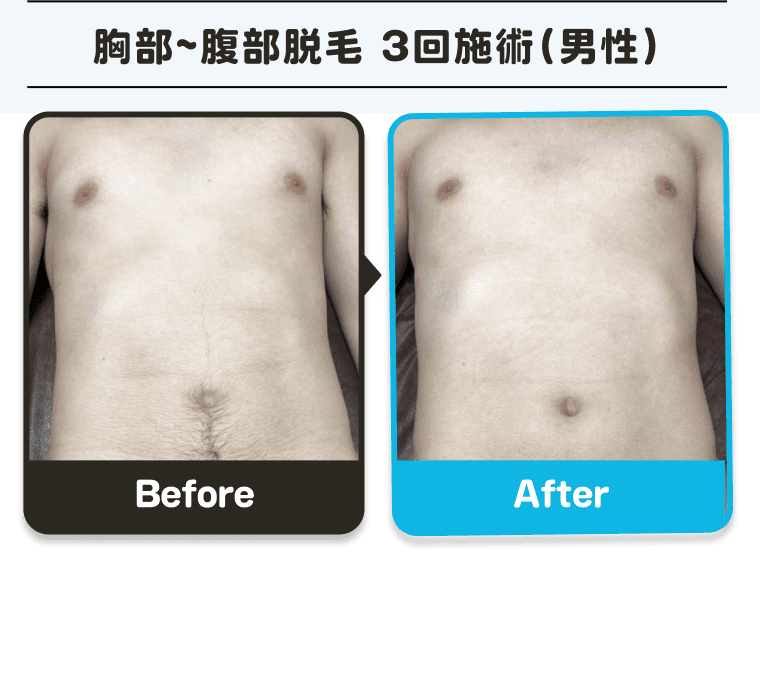 脱毛